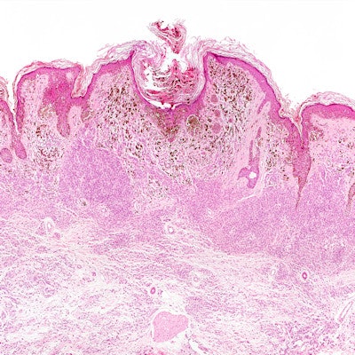 2019 04 22 21 40 3335 Pathology Slide Melanoma 400