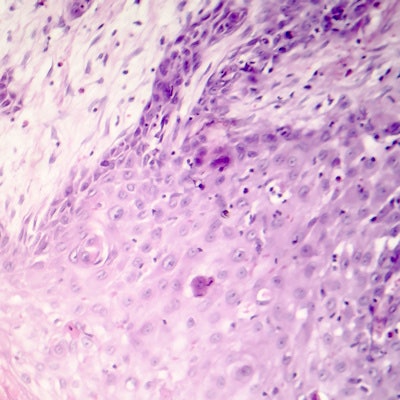 2019 05 07 21 35 9268 Cutaneous Squamous Cell Carcinoma Skin 400