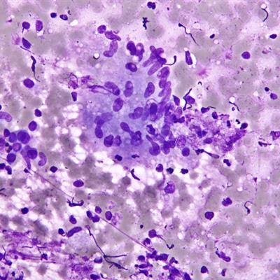 2019 06 27 22 09 2622 Granuloma Cytology Wikimedia 20190627223150