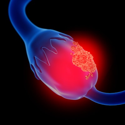 2019 07 02 18 56 7204 Ovarian Cancer 2 400