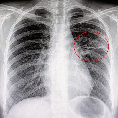 2019 10 02 22 22 3989 Lung Pneumonia Cad 400