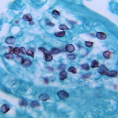 2019 12 23 19 47 2866 Pathology Pneumocystis Jirovecii 400