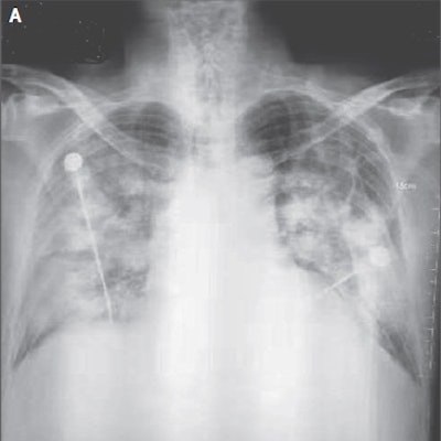 2020 01 25 00 56 6619 Coronavirus X Ray A 400