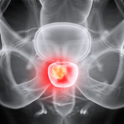 2019 06 19 21 28 0345 Prostate 3 D 400