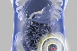 2020 01 08 00 29 4037 Colon Cancer 400