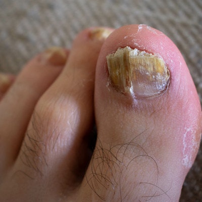 2021 11 03 22 53 1476 Toenail 400