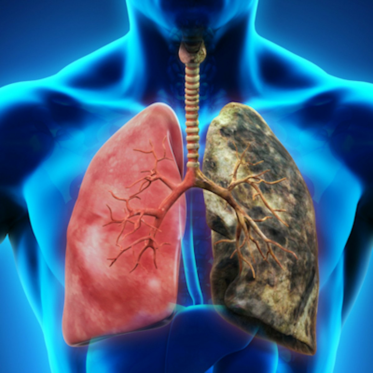 Nucleix advances EpiCheck lung cancer platform | LabPulse.com