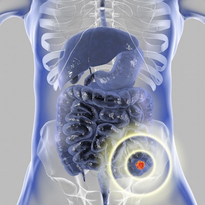 Circulating Tumor DNA Analysis Guiding Adjuvant Therapy in Stage II Colon  Cancer