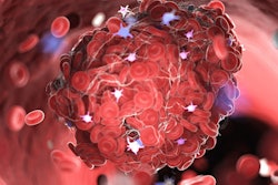 2022 07 26 15 43 0245 Blood Clot 400