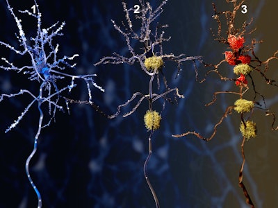 Alzheimers Phases Amyloid