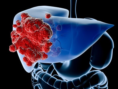 Liver Cancer