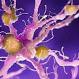 Amyloid Plaque Alzheimer2 Social
