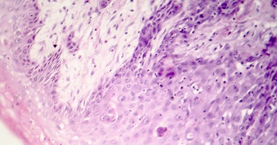 Cutaneous Squamous Cell Carcinoma Skin Social