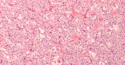 Pancreatic Neuroendocrine Tumor Pnet Social
