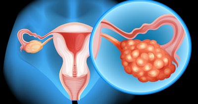 Ovarian Cancer Diagram Social