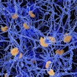 Amyloid Plaque Alzheimer Social