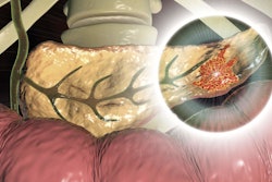 Cancer Pancreatic Social