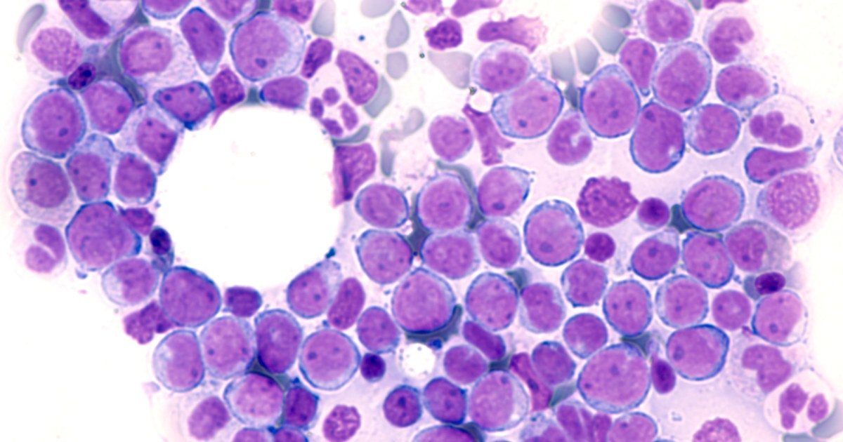 Blood test identifies acute myeloid leukemia patients at greater risk