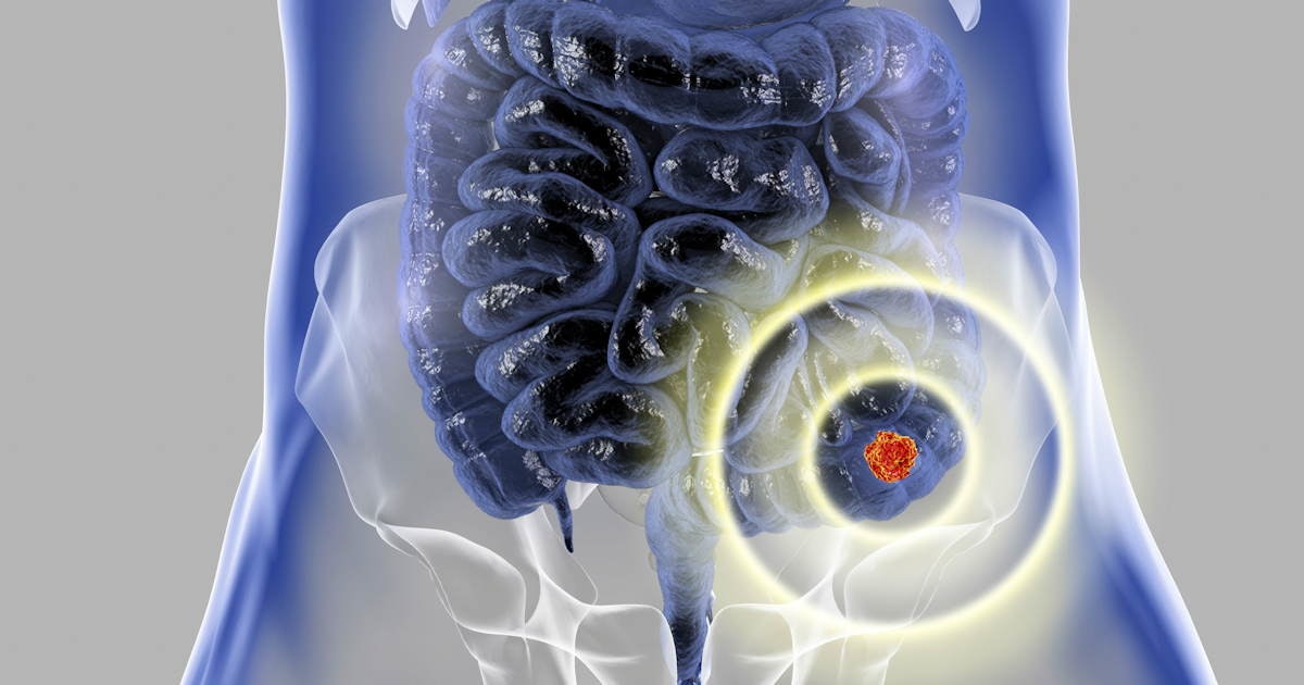 Red flags signal earlyonset colorectal cancer