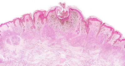 Pathology Slide Melanoma Social