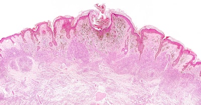 Pathology Slide Melanoma Social