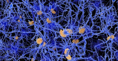 Amyloid Plaque Alzheimer Social