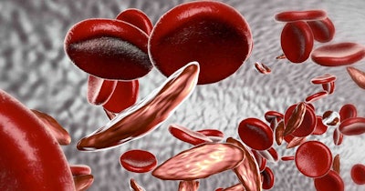 Sickle Cell Anemia2 Social