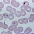 Plasmodium Falciparum Malaria Cdc Social