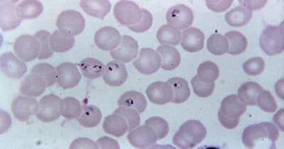 Plasmodium Falciparum Malaria Cdc Social