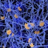 Amyloid Plaque Alzheimer Social