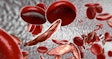 Sickle Cell Anemia2 Social