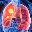 Lung Cancer Hotspot Social