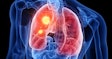 Lung Cancer Hotspot Social